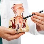 Penyakit Ambeien Disebabkan oleh Apa? Ini Kata Dokter…