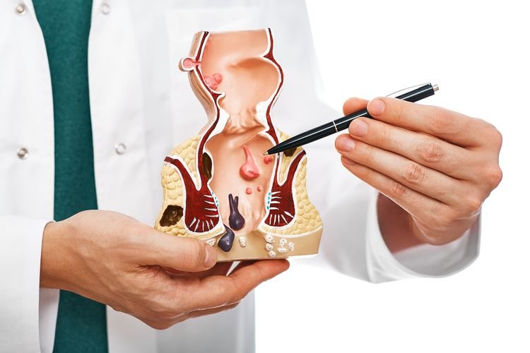 Penyakit Ambeien Disebabkan oleh Apa? Ini Kata Dokter…